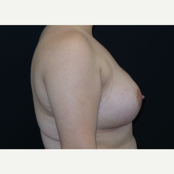 25-34 year old woman treated with Breast Augmentation after 3182014