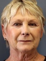 65-74 year old woman treated with Neck Lift before 3103887