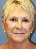 65-74 year old woman treated with Neck Lift after 3103887