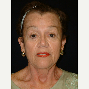65-74 year old woman treated with Facelift after 3170701