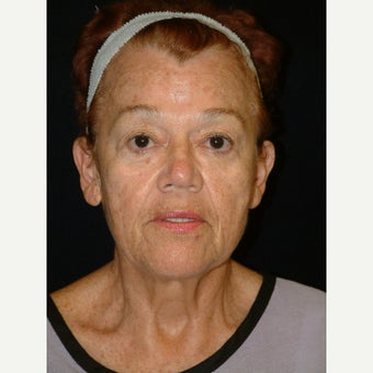 65-74 year old woman treated with Facelift before 3170701
