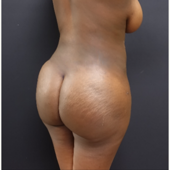 25-34 year old woman treated with Liposculpture after 3363902