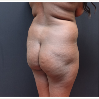 25-34 year old woman treated with Liposculpture before 3363902