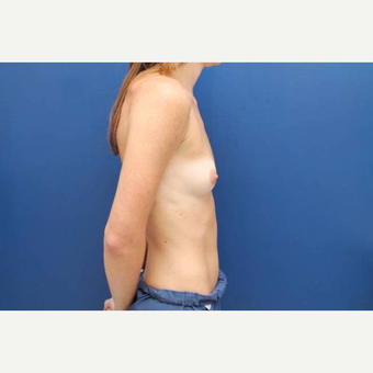 33 year old female, 300cc high profile silicone gel breast implants, submuscular before 3814661