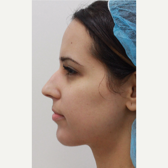 29 year old female treated with Voluma for chin augmentation after 3481903