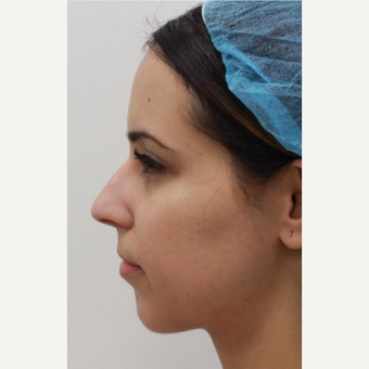 29 year old female treated with Voluma for chin augmentation before 3481903