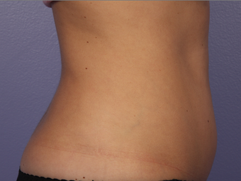 Zeltiq CoolSculpting- Lower Abdomen before 328276