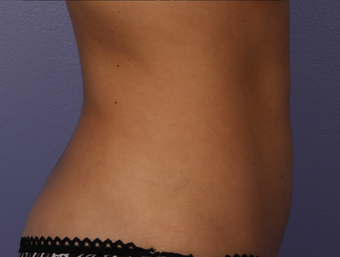 Zeltiq CoolSculpting- Lower Abdomen after 328276