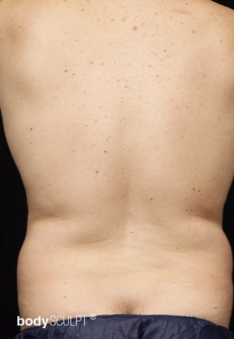 35-44 year old man treated with Smart Lipo Abdomen and Flanks before 3542194