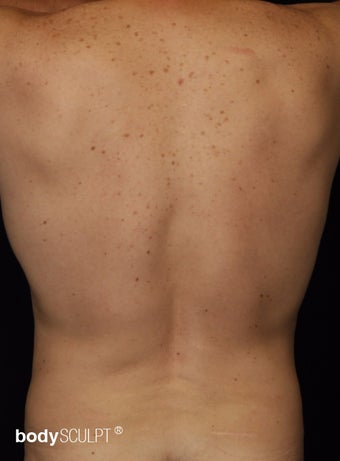 35-44 year old man treated with Smart Lipo Abdomen and Flanks after 3542194