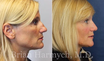 43 year-old female before and 9 months after Rhinoplasty before 3447467