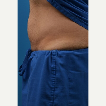 35-44 year old man treated with SculpSure after 3414125