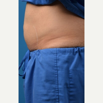 35-44 year old man treated with SculpSure before 3414125