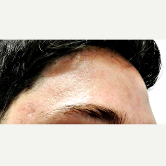 18-24 year old man treated with Isolaz after 3300163