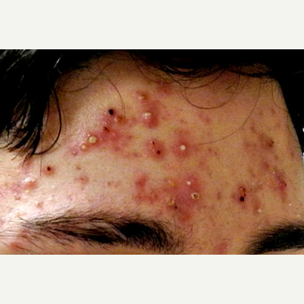18-24 year old man treated with Isolaz before 3300163