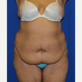 55-64 year old woman treated with No-Drain Tummy Tuck before 3655713