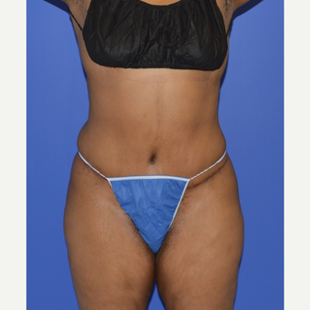 55-64 year old woman treated with No-Drain Tummy Tuck after 3655713
