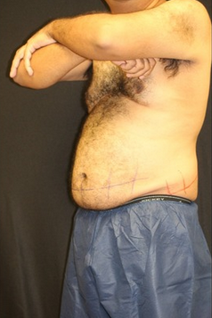 35-44 year old man treated for CoolSculpting for abdomen and love handles before 1528278