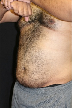 35-44 year old man treated for CoolSculpting for abdomen and love handles after 1528278