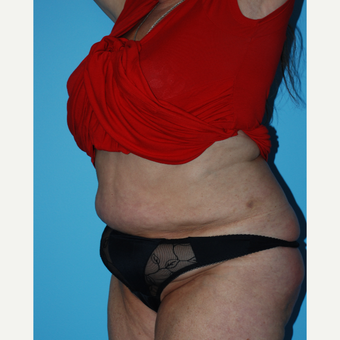 65-74 year old woman treated with SculpSure after 3690204