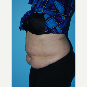 65-74 year old woman treated with SculpSure before 3690204