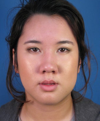 Asian Rhinoplasty Surgery Ethnic Rhinoplasty Example before 895291