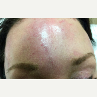 55-64 year old woman treated with Vein Treatment after 3153045
