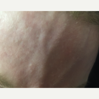 55-64 year old woman treated with Vein Treatment before 3153045