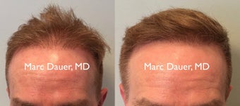 55-64 year old man treated with FUE Hair Transplant before 3377891
