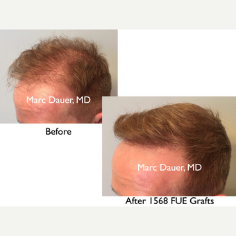 55-64 year old man treated with FUE Hair Transplant after 3377891