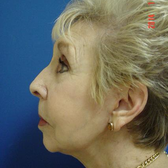 75 and up year old woman treated with Liposuction after 3282396