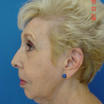 75 and up year old woman treated with Liposuction before 3282396