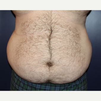 25-34 year old man treated with Male Tummy Tuck before 3093947