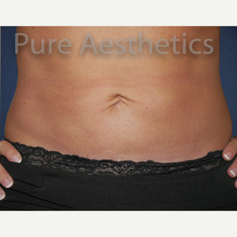 45-54 year old woman treated with CoolSculpting after 3846086