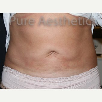 45-54 year old woman treated with CoolSculpting before 3846086