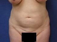 45-54 year old woman treated with Mini Tummy Tuck before 2073540
