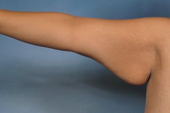 Arm Lift before 112990