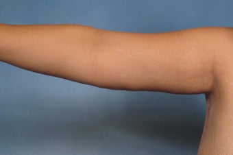 Arm Lift after 112990