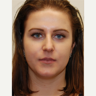 25-34 year old woman treated with Rhinoplasty and permanent Lip Augmentation. before 3742307