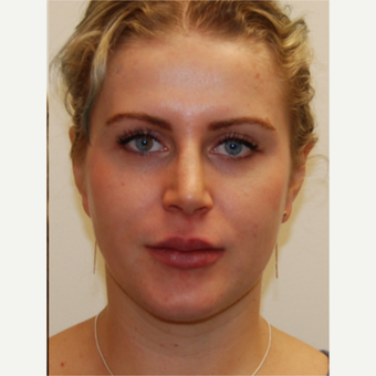 25-34 year old woman treated with Rhinoplasty and permanent Lip Augmentation. after 3742307