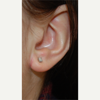 25-34 year old woman treated with Ear Lobe Reduction Surgery after 3508272