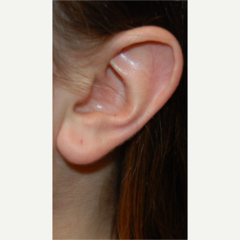 25-34 year old woman treated with Ear Lobe Reduction Surgery before 3508272