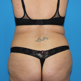 35-44 year old woman treated with Smart Lipo before 3332896