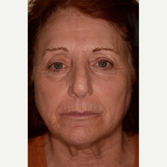 Fraxel Repair for full-face resurfacing after 1953127