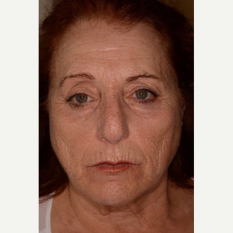 Fraxel Repair for full-face resurfacing before 1953127