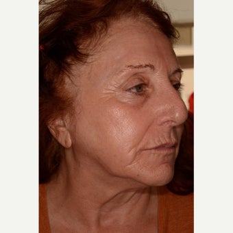 Fraxel Repair for full-face resurfacing 1953127