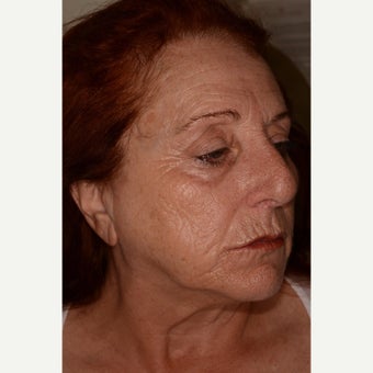 Fraxel Repair for full-face resurfacing 1953127