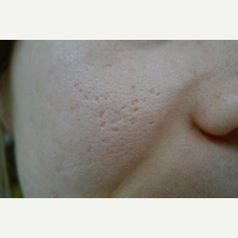 Box car scar treated with TCA CROSS followed by laser before 1751328