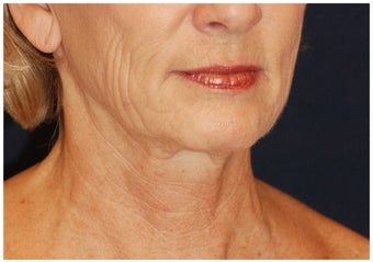 Lower Facial Rejuvenation before 1302467