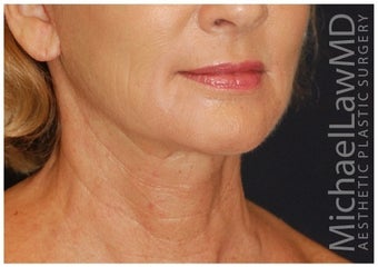Lower Facial Rejuvenation after 1302467